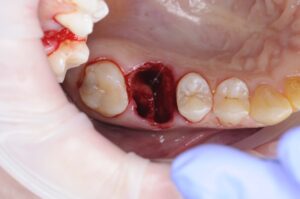 Видалити зуб, удалить зуб киев, хірург стоматолог київ