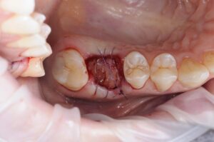 видалення зуба, удаление зуба