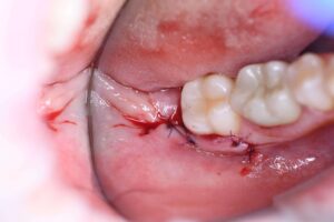 Удаление зубов, удалить зуб отзывы киев, стоматолог хирург отзывы