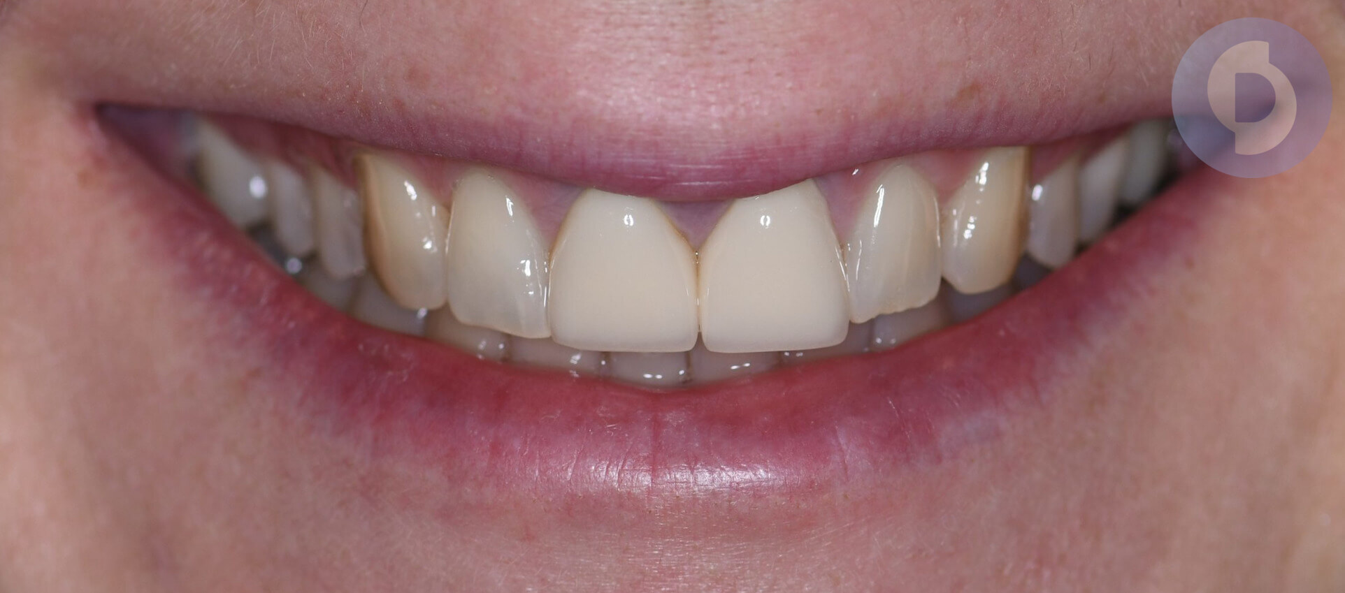 Естетична стоматологія київ, керамічна реставрація, природня посмішка, стоматолог відгуки, реставрація передніх зубів, эстетическая стоматология киев, стоматолог киев отзывы, эстэтическое протезирование, керамика зубы киев отзывы